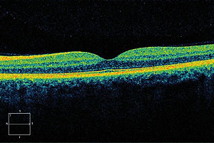 normal-eye-OCT